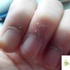 生活小知識(shí)：如何正確處理手上的倒刺？倒刺發(fā)炎了怎么辦？