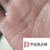 生活小知識：頭發(fā)能不能扎進(jìn)肉里？