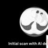 新的GoogleAI可以在CT掃描中檢測出肺癌