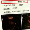 廣東中山一男子腹痛查B超檢出宮內(nèi)胚胎存活