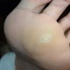 輕度的雞眼可以使用以下兩個(gè)中醫(yī)小秘方 