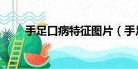 手足口病特征圖片(手足口病特征)