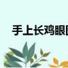 手上長雞眼圖片 原因（手上長雞眼圖片）
