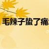 毛辣子蟄了痛怎么辦（毛辣子蟄了怎么止痛）