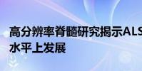 高分辨率脊髓研究揭示ALS如何在遺傳和細(xì)胞水平上發(fā)展